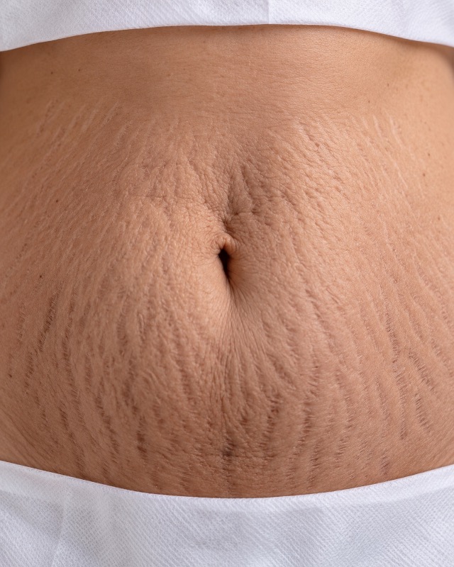 Protocolo Stria Firm — Clínica Pamela Michel